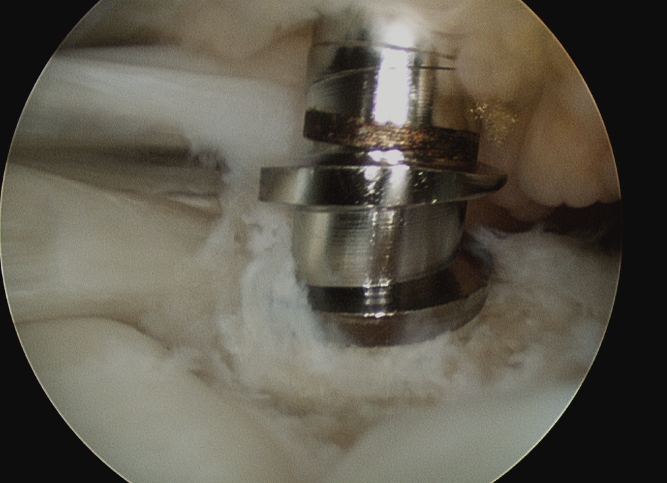 RCR Arthroscopic Tap